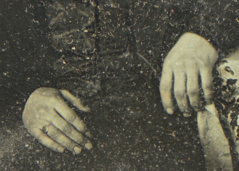 daguerreotype skin disease (5) daguerreotype skin disease (5)